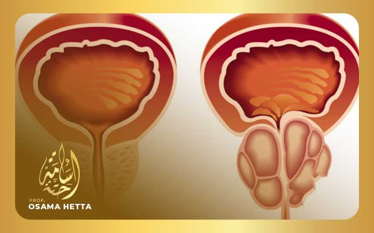 علاج تضخم البروستاتا